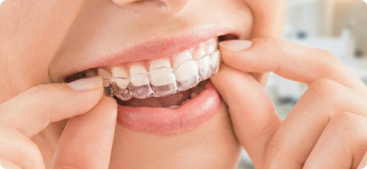 マウスピース矯正（インビザライン）